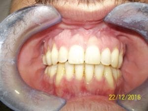 Mordida-abierta-2-min-500x376