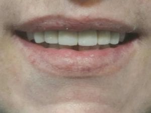 Rehabilitacion-con-fundas-de-porcelana-2-min-500x375