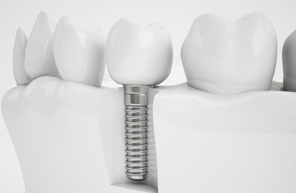 Implantes de carga inmediata e Implantes especiales