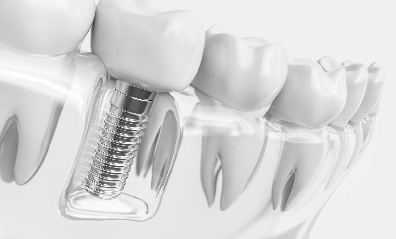 Prótesis fabricadas con tecnología CAD-CAM dental