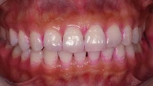 blanqueamiento dental