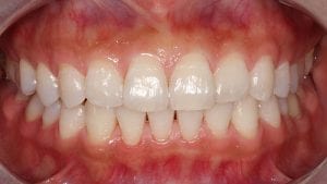 blanqueamiento dental