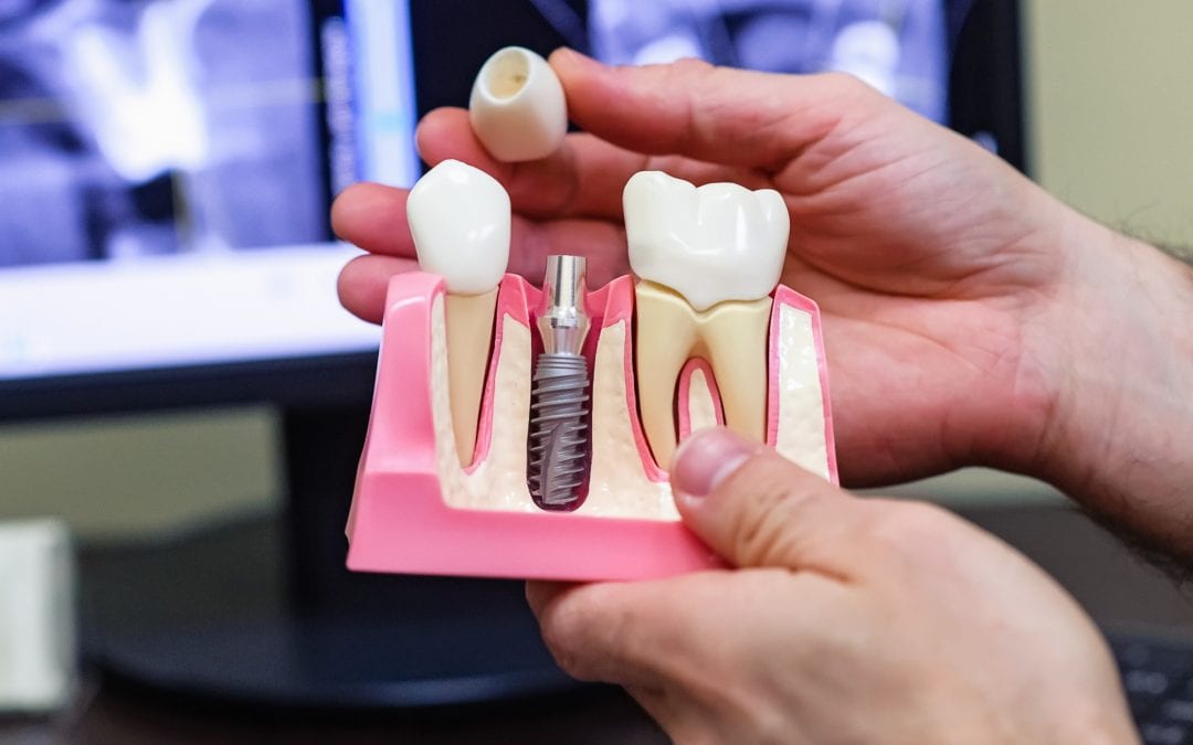 Implantes dentales y sus beneficios