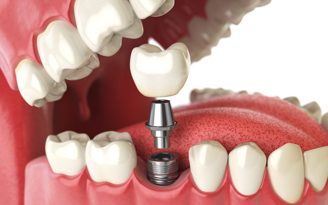 Implantes dentales de carga inmediata