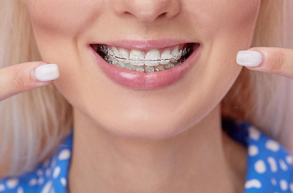 Diferencia entre brackets Damon y los tradicionales