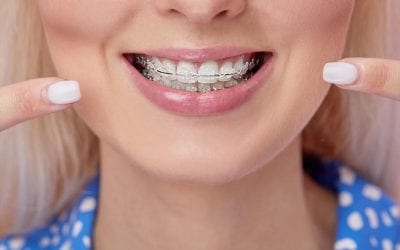 Diferencia entre brackets Damon y los tradicionales