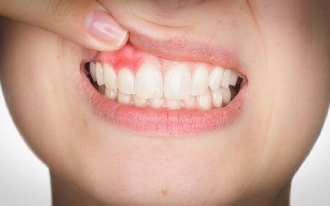 Enfermedades dentales comunes