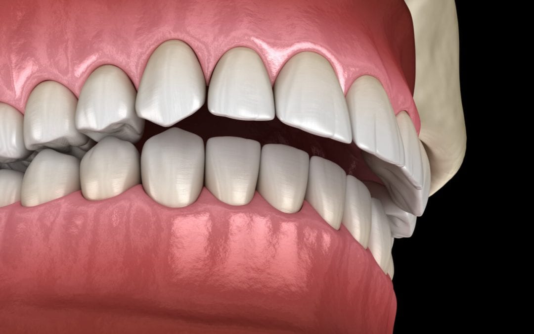 Sobremordida: Diferencias entre Invisalign y brackets