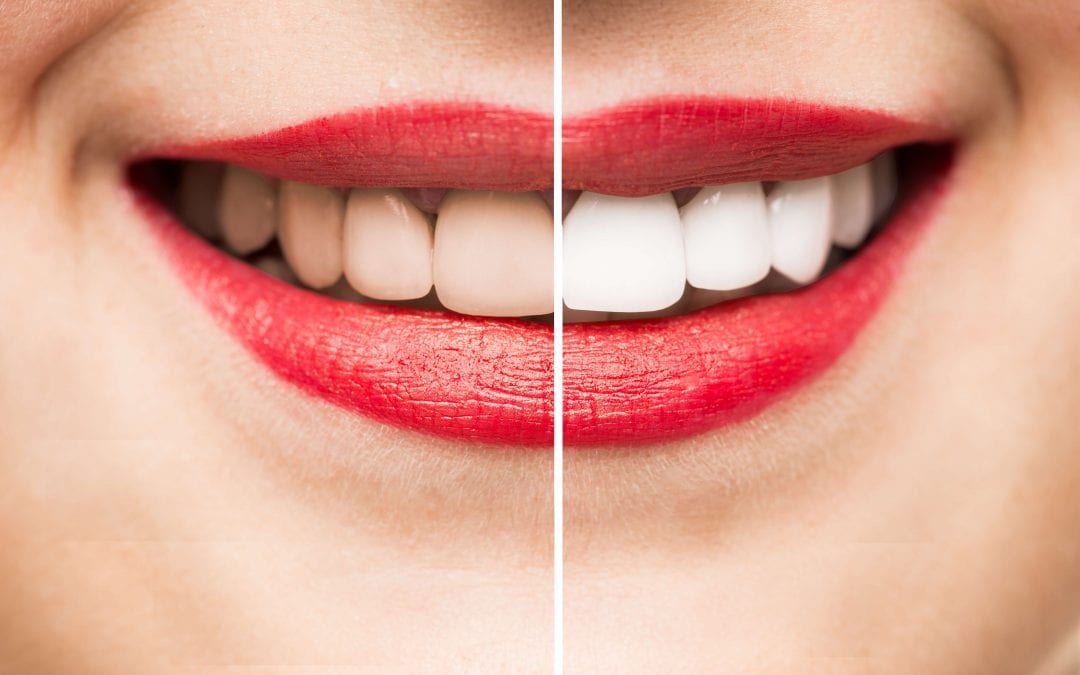 ¿Qué es el blanqueamiento dental con luz?
