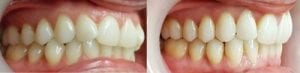 ortodoncia invisible antes y despues
