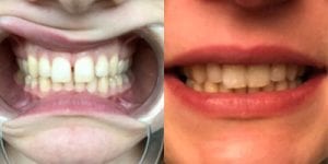 ortodoncia invisible antes y despues