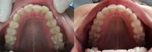 ortodoncia invisible antes y despues