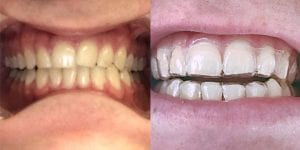 ortodoncia invisible antes y despues