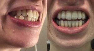 ortodoncia invisible antes y despues