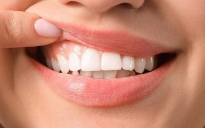 4 causas de los puntos negros en encías
