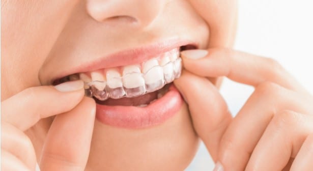 Cuánto cuesta una ortodoncia invisible en España