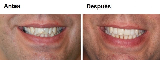 antes y despues invisalign