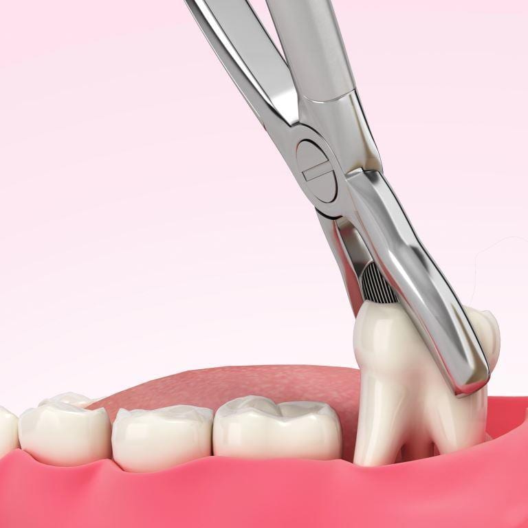 Muelas del juicio Grupogentevital