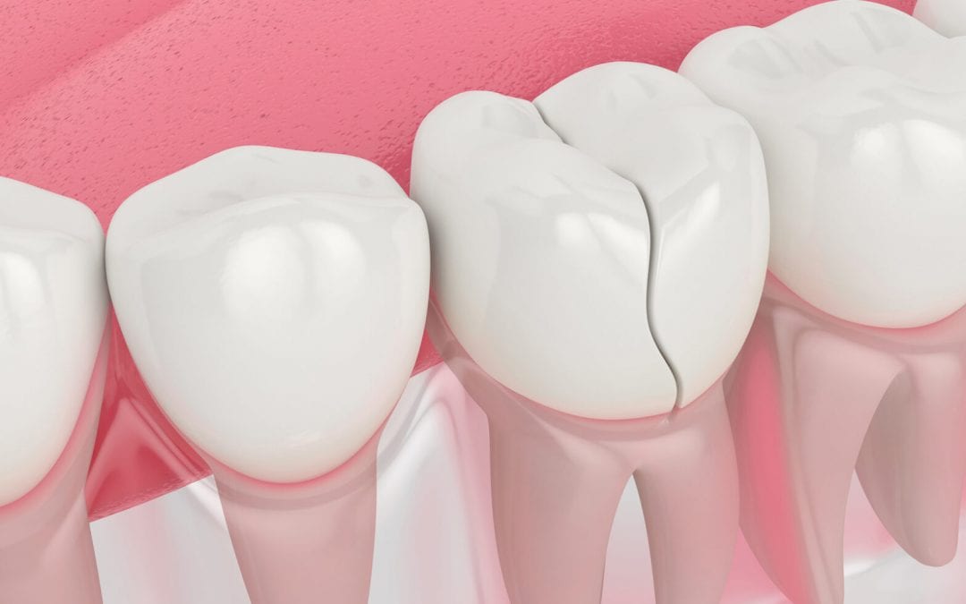 Dientes agrietados