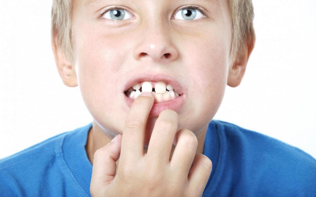 Diastema