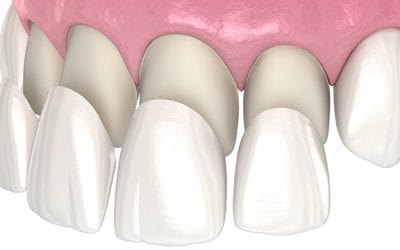 Descubre el Poder Transformador de las Carillas Dentales