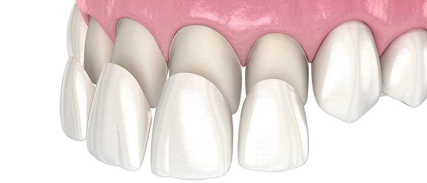 Descubre el Poder Transformador de las Carillas Dentales