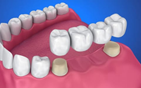puente dental