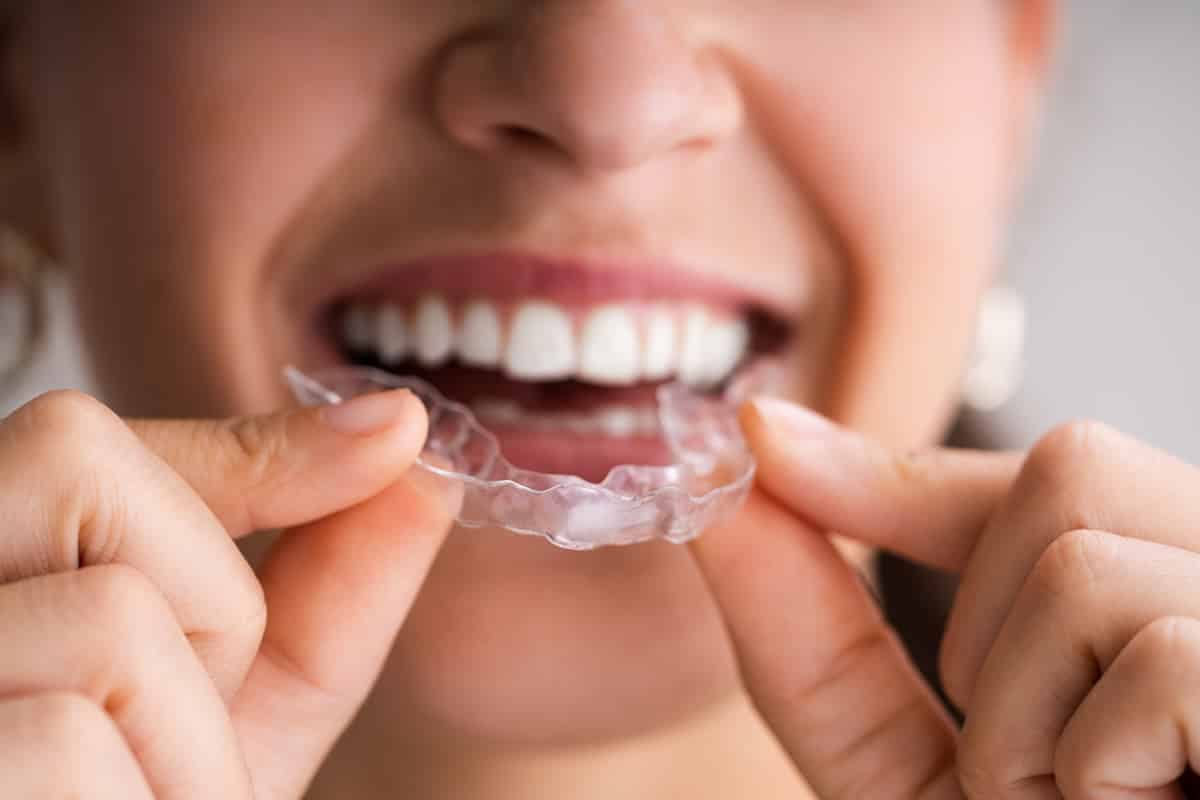 Invisalign para sobremordida