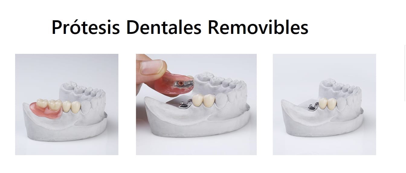 prótesis dentales removibles