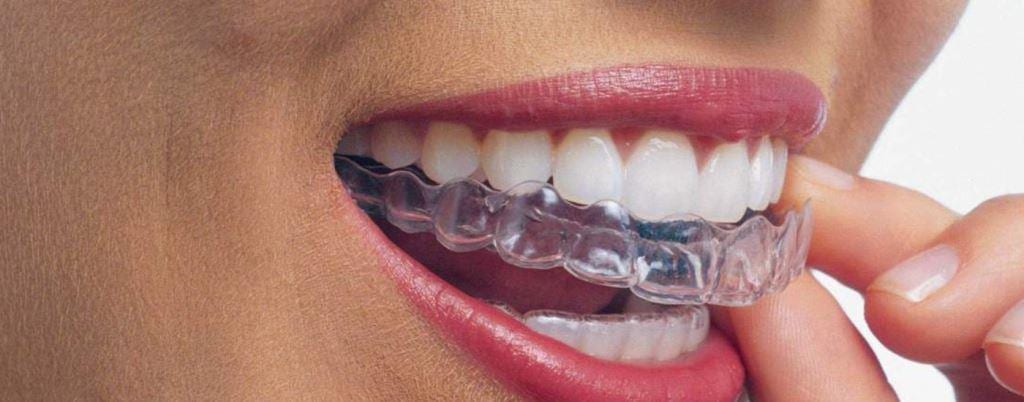 Férulas de descarga