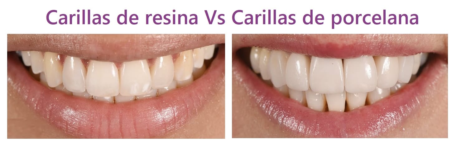 carillas de resina o carillas de porcelana