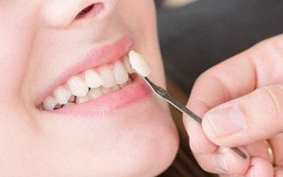 Precio de las carillas dentales: una guía completa para encontrar la mejor opción