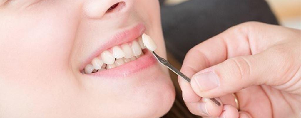 Precio de las carillas dentales: una guía completa para encontrar la mejor opción