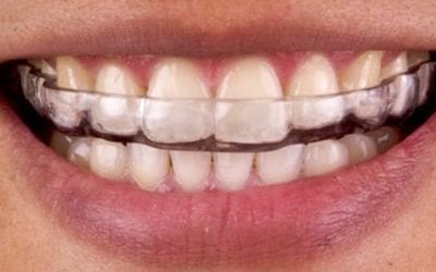 Beneficios de la férula de descarga