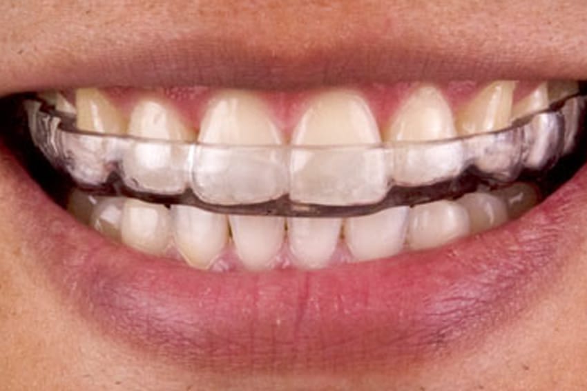 Beneficios de la férula de descarga