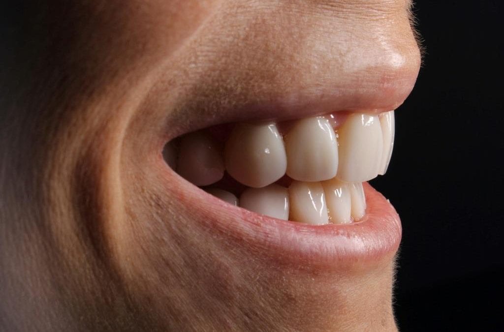 Oclusión o Mordida Abierta