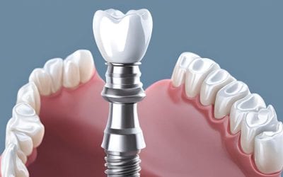 Soluciones para la pérdida de dientes y falta de hueso
