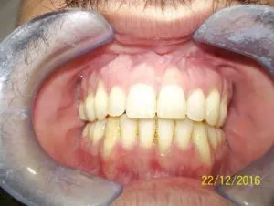 Mordida-abierta-2-min-500x376