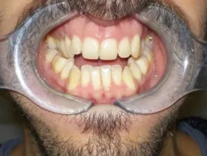 Mordida abierta anterior ANTES 2