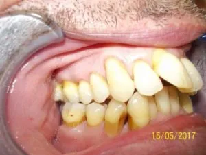 Mordida abierta anterior ANTES