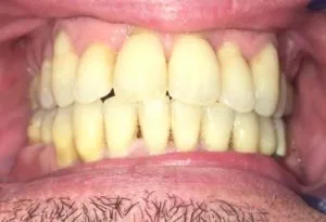 Mordida abierta anterior 2 ANTES