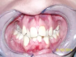 Mordida cruzada unilateral antes