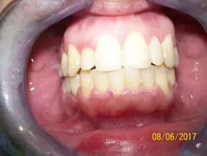 Mordida cruzada unilateral DESPUES