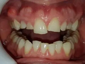 Paciente con agenesia de laterales y caninos superiores incluidos ANTES