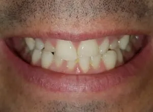 Paciente con agenesia de laterales y caninos superiores incluidos DESPUES 1