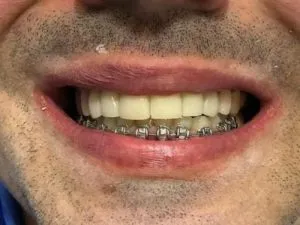 Paciente con agenesia de laterales y caninos superiores incluidos DESPUES 2