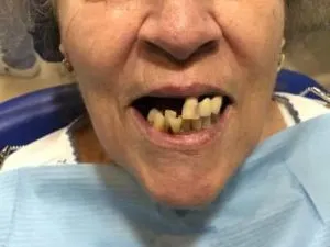 REHABILITACION CON IMPLANTES ANTES