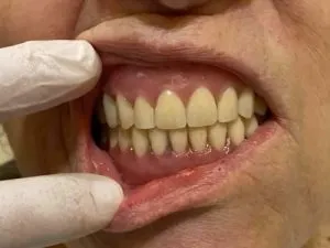 REHABILITACION CON IMPLANTES DESPUES 2