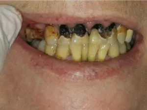 Rehabilitacion-con-fundas-de-porcelana-1-min-500x375