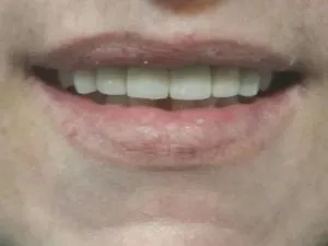 Rehabilitacion-con-fundas-de-porcelana-2-min-500x375